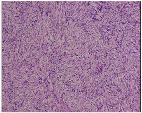 Histopathology of dermatofibrosarcoma protuberance reveals spindled cells arranged in a storiform pattern. [Haematoxylin and eosin, 100x].