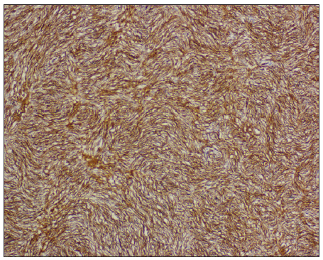 Immunohistochemistry of dermatofibrosarcoma protuberance demonstrates positive staining for CD34 [IHC, 100x].