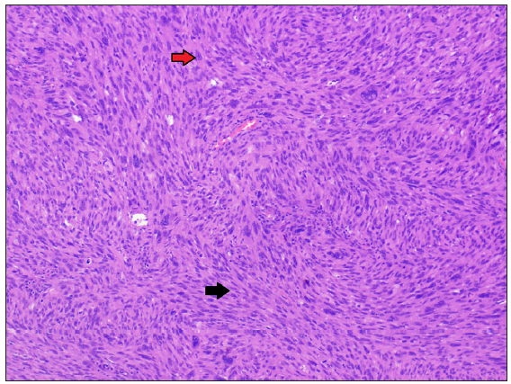 Histopathology of malignant peripheral nerve sheath tumour reveals epitheloid cell-like (red arrow) and spindled cells (black arrow) in a storiform pattern embedded in a mucinous stroma [Haematoxylin and eosin, 100x].