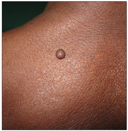 Pigmented neurofibroma: Solitary brown dome-shaped papule.