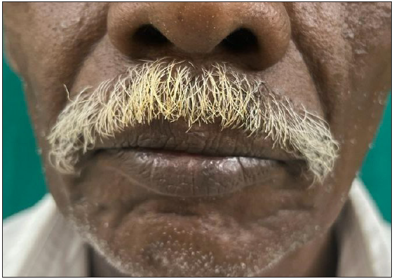 Yellowish discoloration of the moustache in smokers.