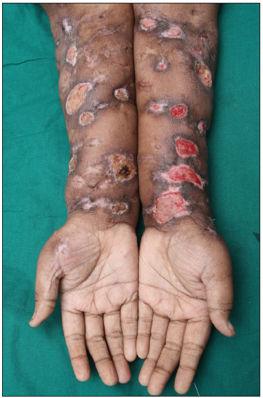 Multiple shallow irregular ulcers with surrounding hyperpigmentation and woody fibrosis.