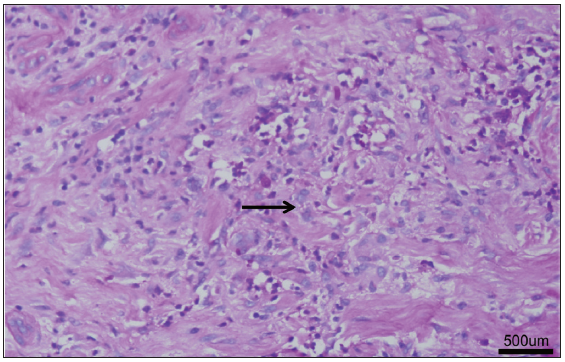 Histopathological examination demonstrated positive fungal spores findings on the dermis based on the periodic acid-Schiff stain (Haematoxylin–eosin; bar: 500 μm).