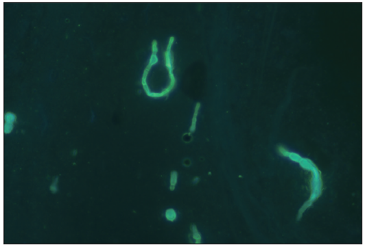 Direct microscopic examination with fluorescent staining of the scrapped material revealed club-shaped conidia (400x).