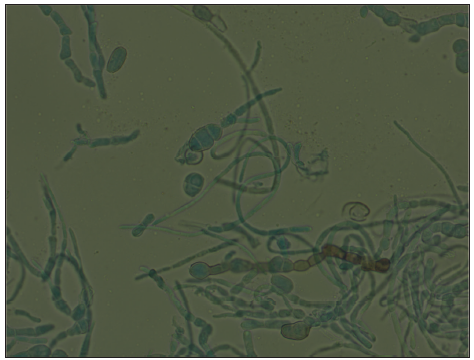 Fungal tissue culture with lactophenol cotton blue mount showing brown septate hyphae and multiple darkly pigmented, ovoidal conidia muriformes (400x).