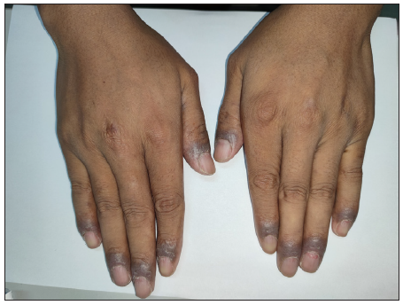 Lichenoid chronic cutaneous lesions with dark brown patches around the nails of both hands.