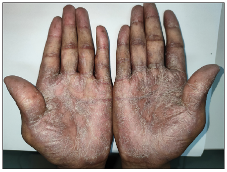 Lichenoid chronic cutaneous lesions with diffuse hyperpigmented plaques and desquamation on both palms.