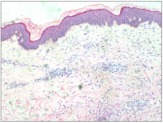 Focal mild hyperplasia of the epidermis is observed, with a high infiltration of lymphocytes and eosinophils in the small blood vessels of the superficial dermis. Haematoxylin and eosin, 100x).