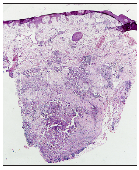 Dense nodular infiltrate in the mid and deep dermis (Haematoxylin and eosin, 20x)