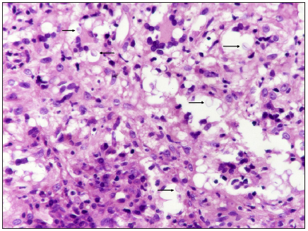 Infiltrate is composed of histiocytes, lymphocytes, and plasma cells, accompanied by numerous giant cells containing pale basophilic oval yeast forms -black arrow (Haematoxylin and eosin, 400x)