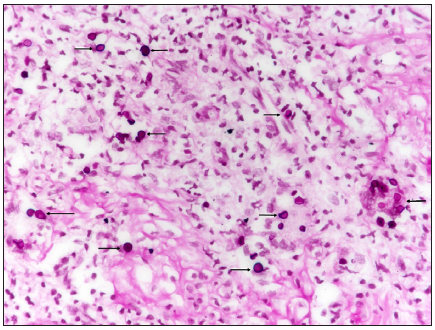 Encapsulated fungal yeast forms - black arrow (Periodic acid-Schiff, 400x)