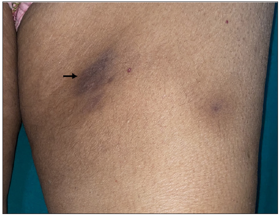 Solitary plaque on the thigh. Softening and flattening of the plaque (black arrow) after the end of consolidation phase.