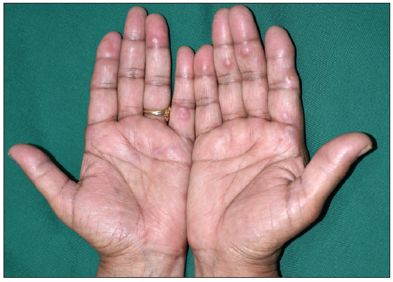 Erythematous papules and nodules with central umbilication on both palms.