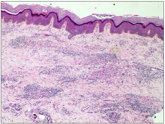 Perivascular and interstitial infiltrate in the superficial and deep dermis (Haematoxylin and eosin, 100x)