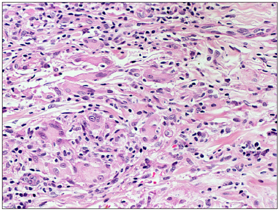 Infiltrate is composed of histiocytes and lymphocytes along with a few small collections of epitheloid histiocytes and multinucleated giant cells (Haematoxylin and eosin, 400x).