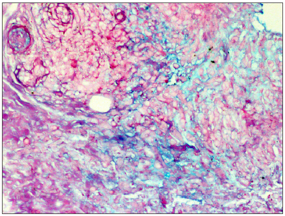 Alcian blue stain highlighting the dermal mucin deposition (400x).