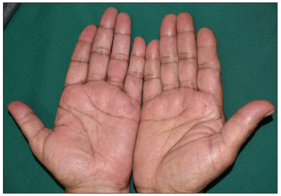 Complete resolution of lesions on palms after 3 months of treatment.