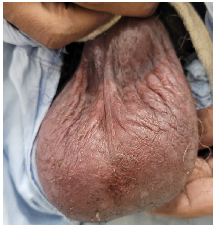 Erythematous oozy plaques on the scrotum.