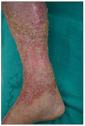 Erythematous oozy crusted plaques involving the lower half right leg.