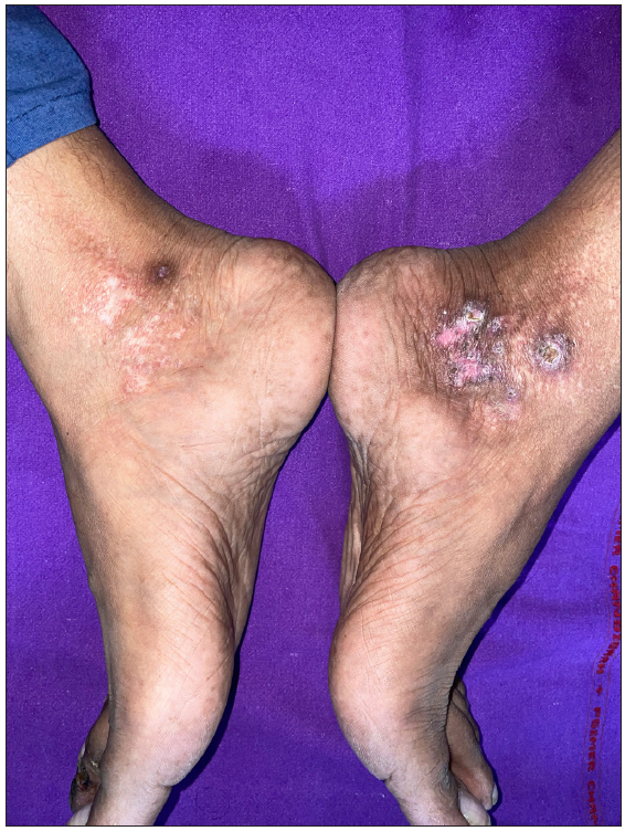 Multiple well-defined ulcers with irregular borders on the medial malleolar region with adherent yellowish-brown crusting on the surface.