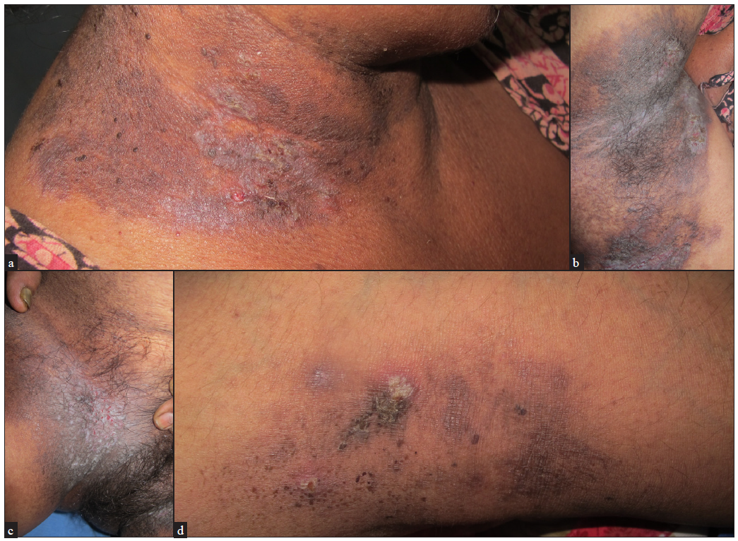 Presence of flaccid vesicles, erosions and macerated crusted plaques (a) over the neck, (b) axilla, (c) groin and (d) popliteal fossa.