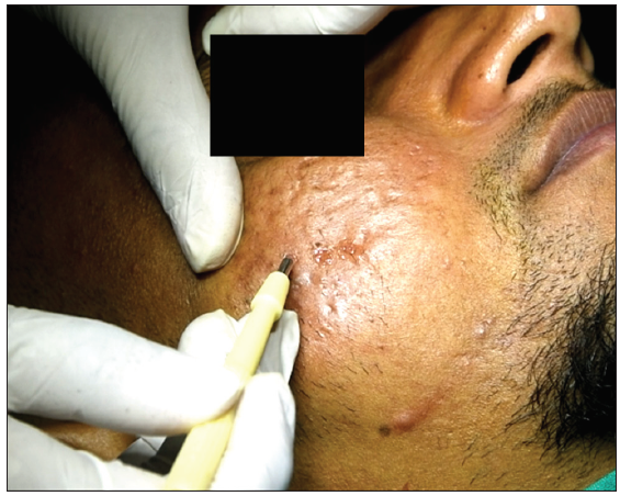 Intra-operative: Punch excision of individual recipient area scars.
