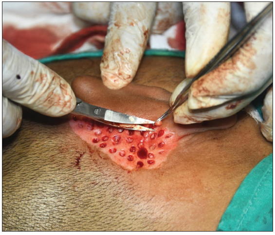 Harvesting dermal grafts from donor site (retroauricular area).