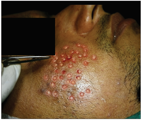 Transfer of dermal graft to recipient area over an individual scar.