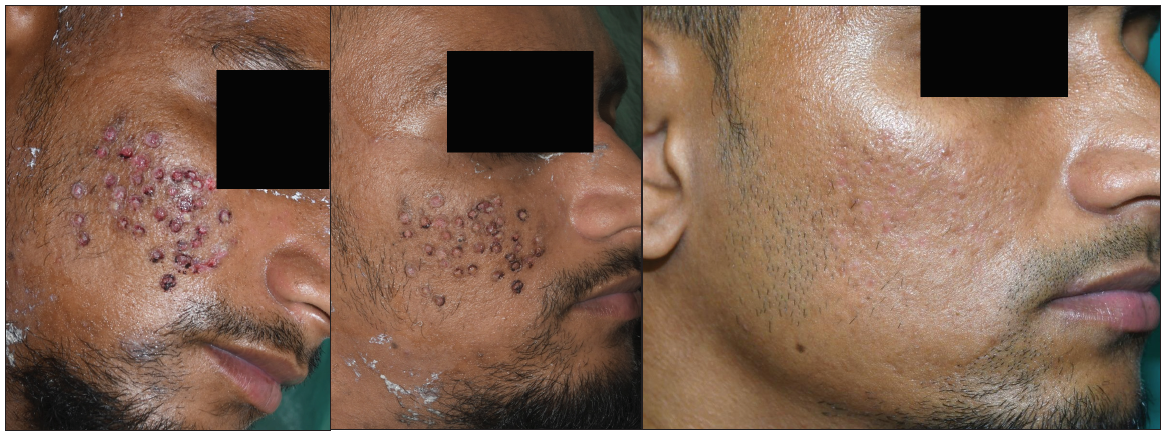 (c) Recipient area after 7 days of treatment, (d) after 14 days and (e) after 1 month of treatment.