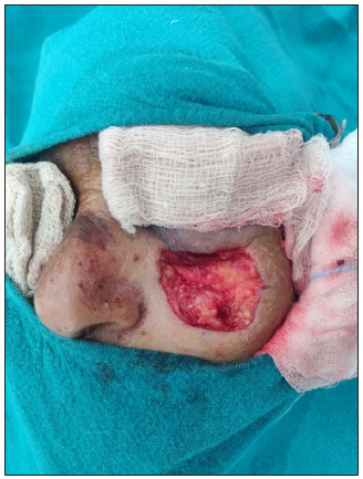 Full-thickness defect after tumour excision plus 1–2 mm margin of surrounding clinically normal tissue.