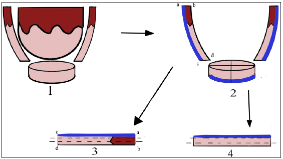 Diagrammatic representation of the procedure (dark brown - epidermis; beige – dermis; blue/indigo – inking). (Subpart 1: At first, the tumour is excised and thereafter the radial and deeper margins are excised. Subpart 2: The deeper margin disc may or may not be divided into four bits intra-operatively. Subpart 3 and 4: show the orientation of side/radial and deep margins to keep the ink side up during embedding and sectioning. The outer side and deeper margins are inked and oriented and sent to pathology where they are washed and re-inked and all tissue bits are processed separately and sectioned horizontally inked side up.)