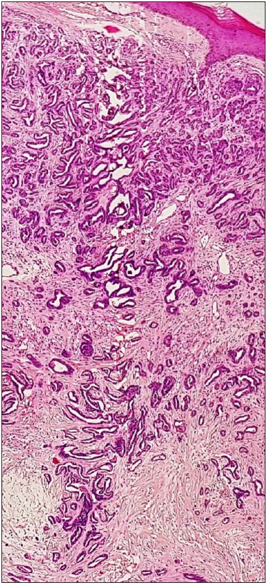 Tumour is composed of multiple variably dialated and anastomosing duct like structures in the dermis (Haematoxylin and eosin, x40).