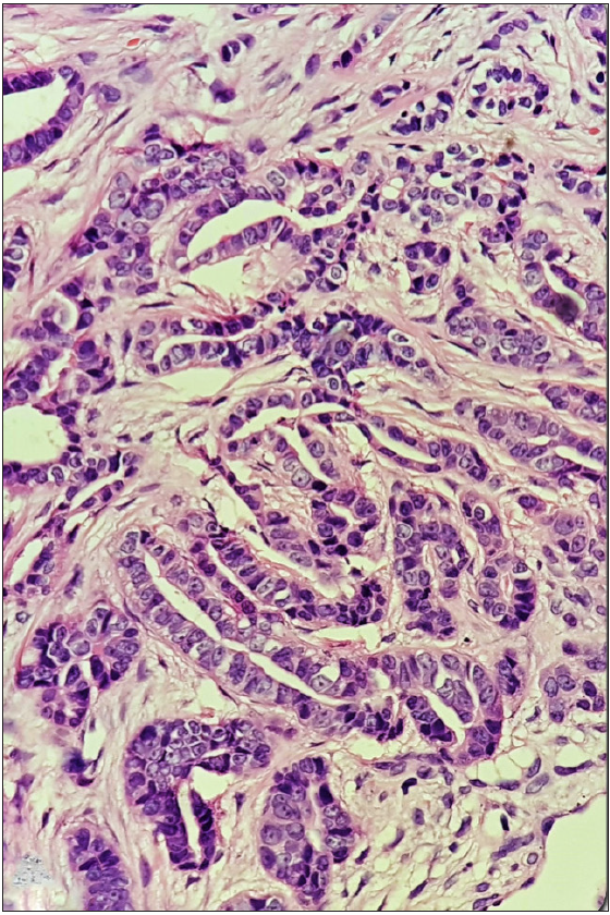 Tumour composed of multiple variably dialated and anastomosing duct like structures in the dermis (Haematoxylin and eosin, x400).