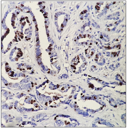 Tumour cells showing positivity for Ki 67 (IHC-Ki67; ×100).