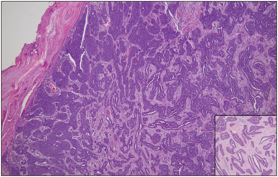 Histopathology image from verrucous plaque showing marked hyperkeratosis and parakeratosis. Entire dermis is infiltrated by a tumour composed of ducts and solid areas. (H&E x40). Inset show tumour in high magnification (x400).