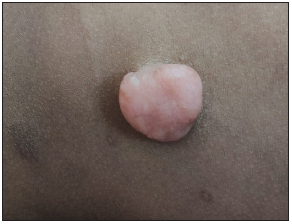 Pedunculated pink nodule with telangiectasia on the lower back.