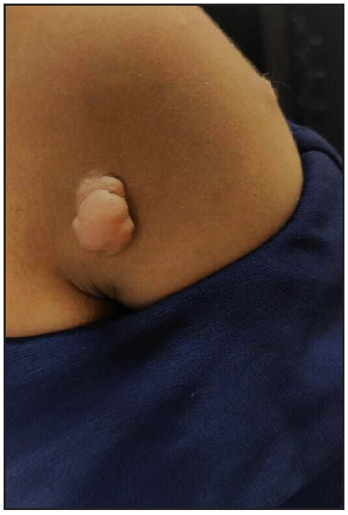 Pedunculated skin-coloured nodule on the right shoulder.