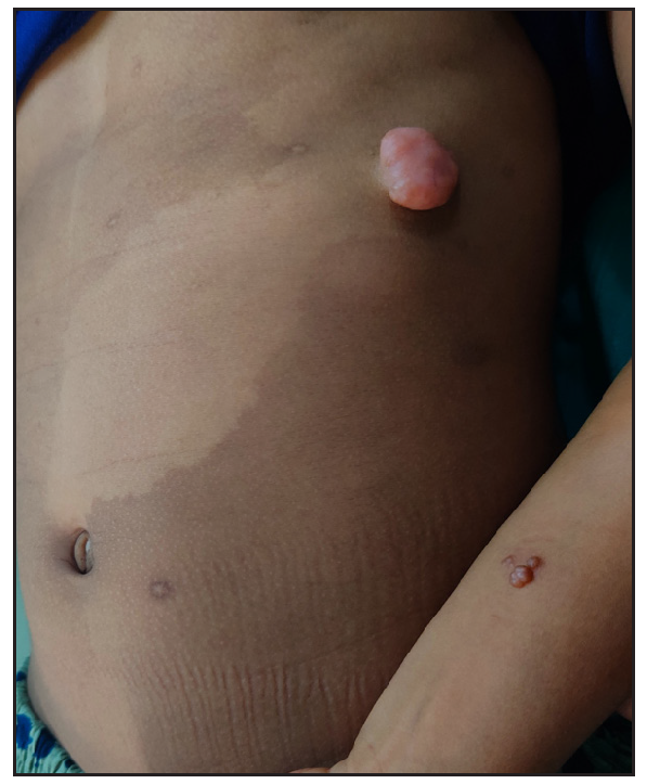 A large naevus depigmentosus on the left side of the chest wall with a pedunculated nodule on its lower border and sessile nodules on the left forearm.