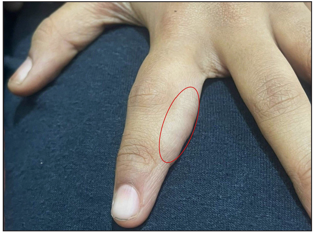 Linear skin-coloured nodule on the medial border of the left index finger seen within the red circle.