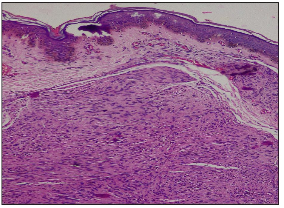 Reticular dermis showing a neoplasm composed of spindle-shaped cells showing central anuclear zone with peripheral nuclear palisading (Haematoxylin and eosin,100x).