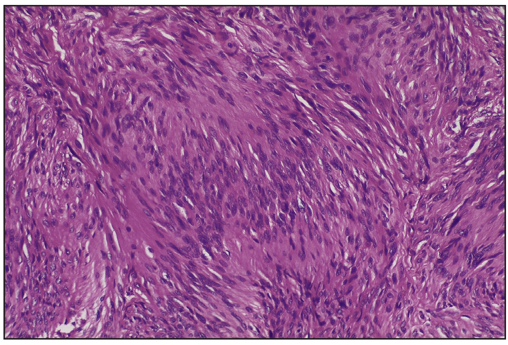 Verocay bodies with the central anuclear zone (Antoni A) (Haematoxylin and eosin, 400x).