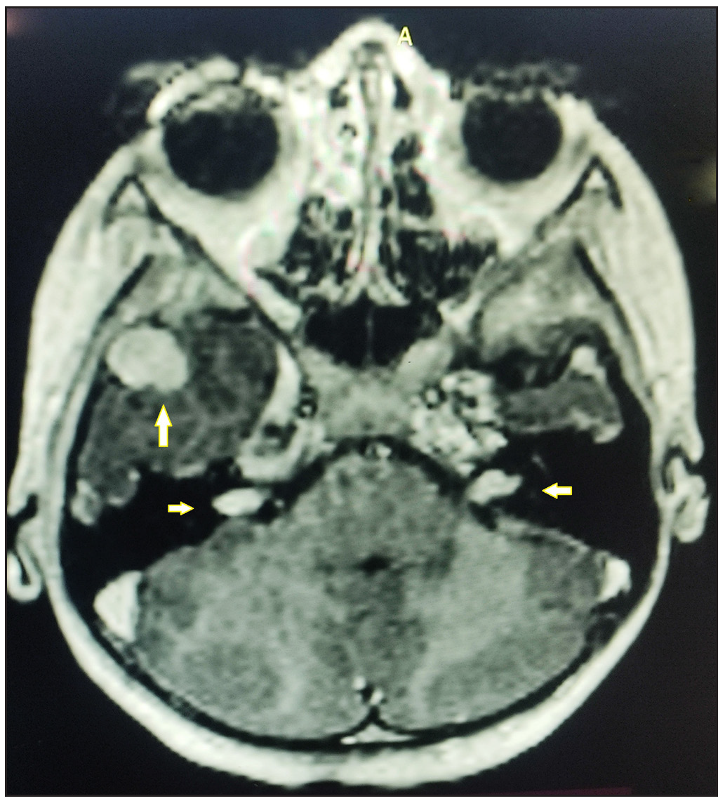 Brain MRI shows bilateral vestibular schwannomas (horizontal arrows) and meningioma in the right middle cranial fossa (vertical arrow).