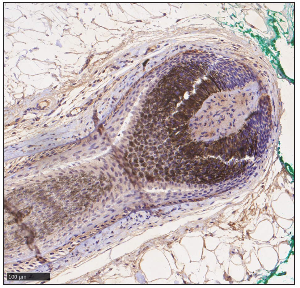 Immunohistochemical staining shows negative type II 5α-reductase (SRD5A2) at the lesions (anti-SRD5A2, BS-6700R, Bioss).