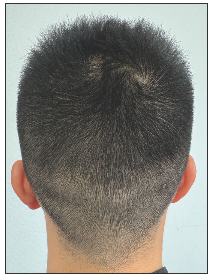 No significant decrease in hair density over the occipital area.