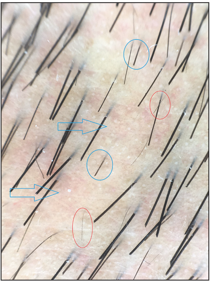 Trichoscopic photograph (taken by fotofinder, 40× of the left side reveals partial hair loss (blue arrows), uneven hair thickness (red circles), and suspicious broken hairs (blue circles).