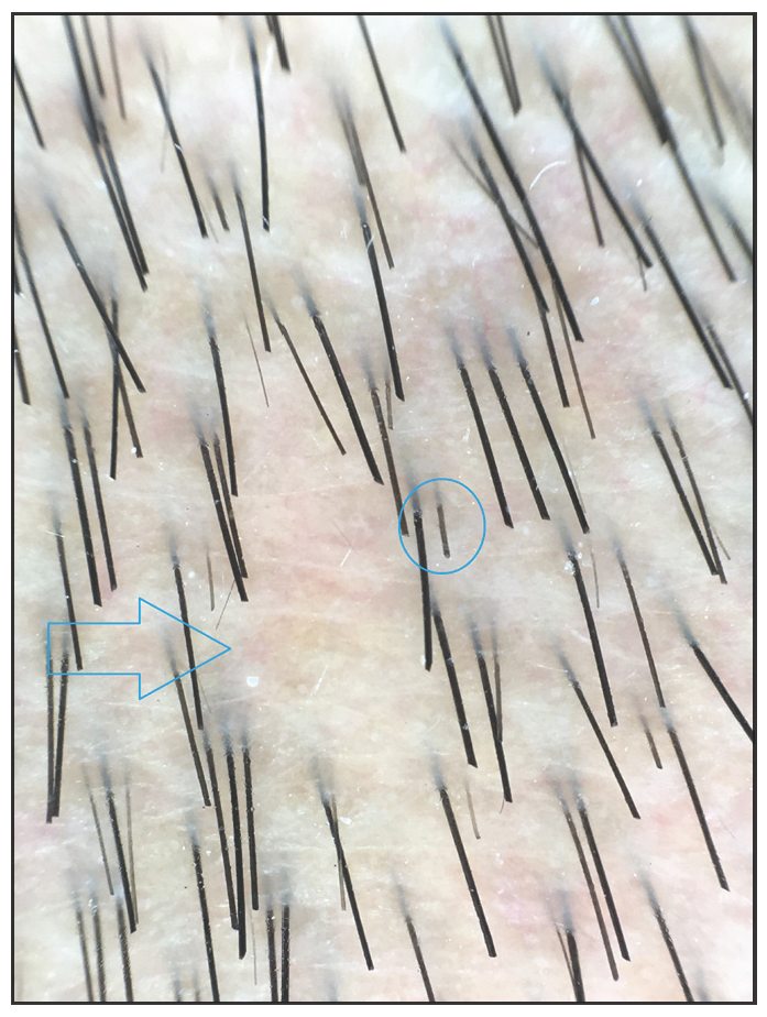 Trichoscopic photograph (taken by fotofinder, 40× of the right side reveals partial hair loss (blue arrows) and suspicious broken hairs (blue circles).