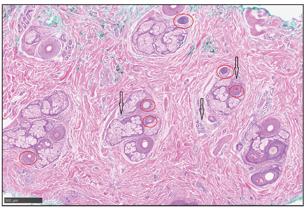 Transverse Haematoxylin-eosin staining (200×) shows that a reduced number of hairs, miniaturised hairs (red circles), and a small amount of chronic lymphocytes infiltration around the focal hair follicles and sebaceous glands (black arrows).