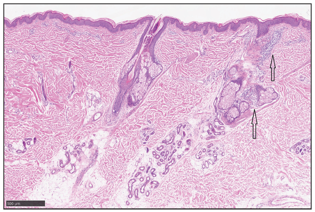 Longitudinal Haematoxylin-eosin staining (200×) shows a small amount of chronic lymphocytes infiltration around the focal hair follicles and sebaceous glands (black arrows).