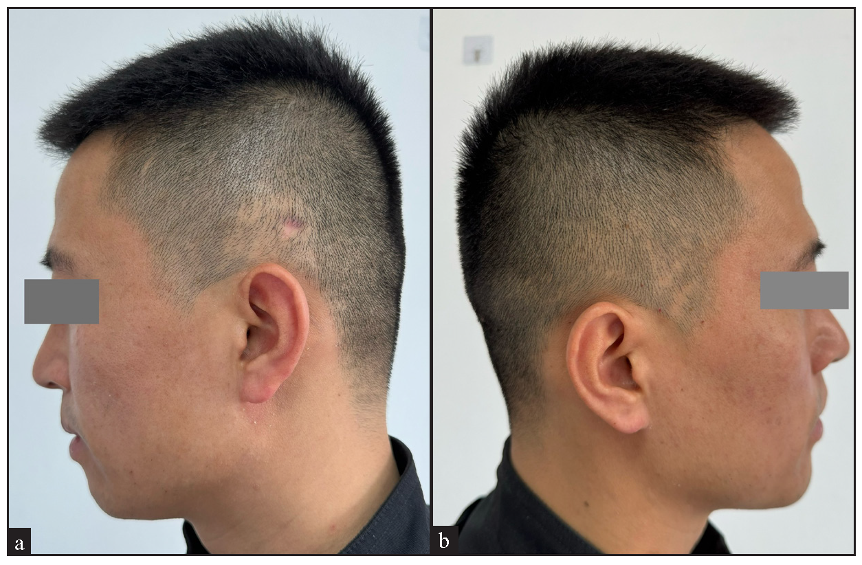 Seven months post treatment, patient showed no significant growth on the left and right side of the scalp.