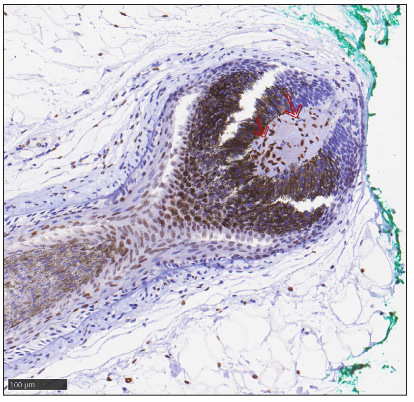 Immunohistochemical staining shows marked expression of androgen receptor (AR) in dermal papilla cells (red arrows) at the lesion (anti-androgen receptor, ab133273, abcam).